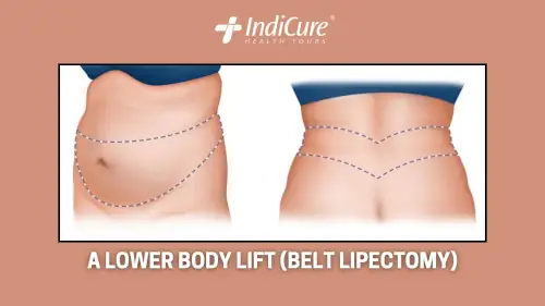 A lower body lift (belt lipectomy)